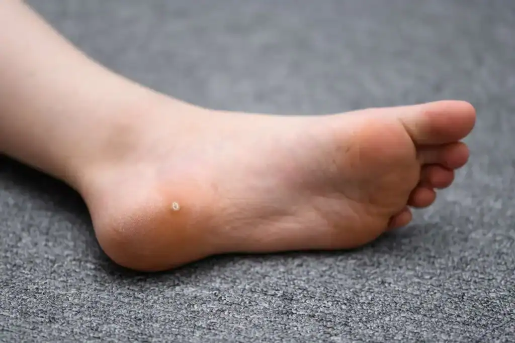 Image of verruca on the bottom of the foot that able to be treated with Cryotherapy Buckinghamshire