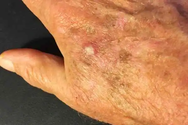 Image of Actinic keratoses Buckinghamshire on a person hand