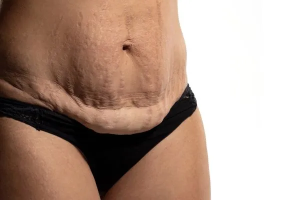 The science behind skin tightening Buckinghamshire picture of a woman's sagging skin on the stomach